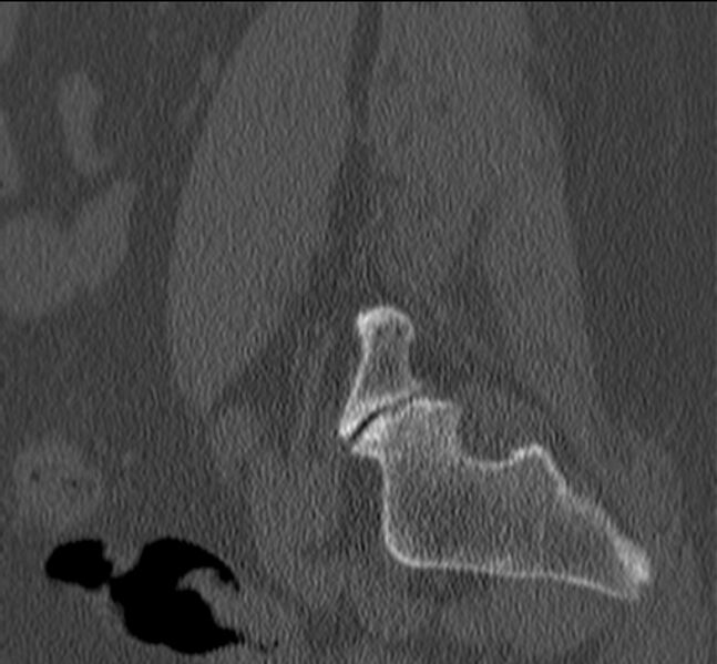 File:Bertolotti syndrome (Radiopaedia 24864-25128 Sagittal bone window 46).jpg