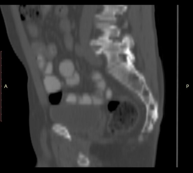 File:Bertolotti syndrome (Radiopaedia 58974-66235 Sagittal bone window 15).jpg