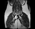 Bicornuate bicollis uterus (Radiopaedia 61626-69616 Coronal T2 29).jpg