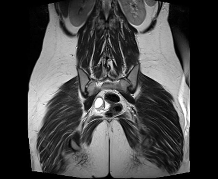 File:Bicornuate bicollis uterus (Radiopaedia 61626-69616 Coronal T2 29).jpg