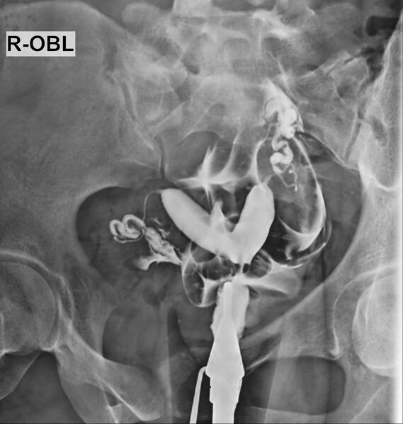 File:Bicornuate vs septate uterus (Radiopaedia 62784-71120 G 1).jpg
