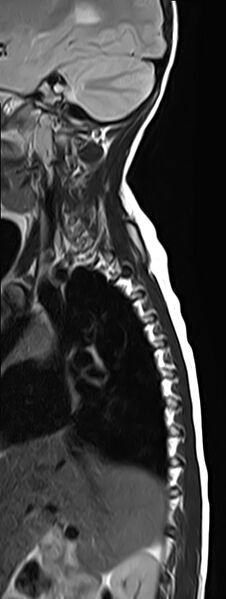 File:Bilateral Sprengel deformity with Klippel-Feil syndrome (Radiopaedia 66395-75650 Sagittal T2 1).jpg