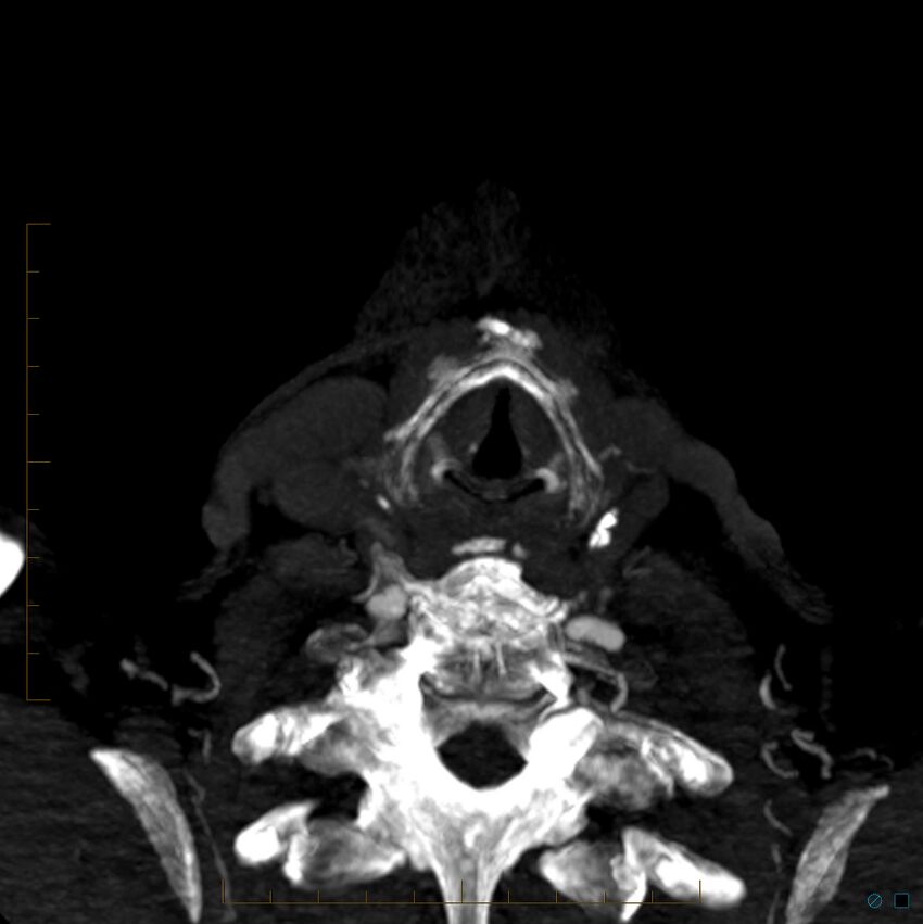 Bilateral chronic common carotid occlusion (Radiopaedia 50849-56362 D 46).jpg