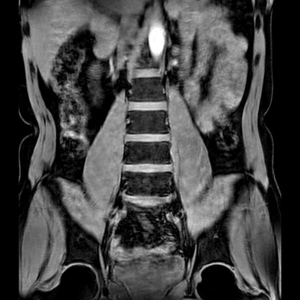 File:Bilateral conjoined nerve roots at different levels (Radiopaedia 73312-84063 Coronal WE 16).jpg