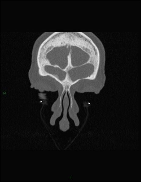 File:Bilateral frontal mucoceles (Radiopaedia 82352-96454 Coronal 54).jpg