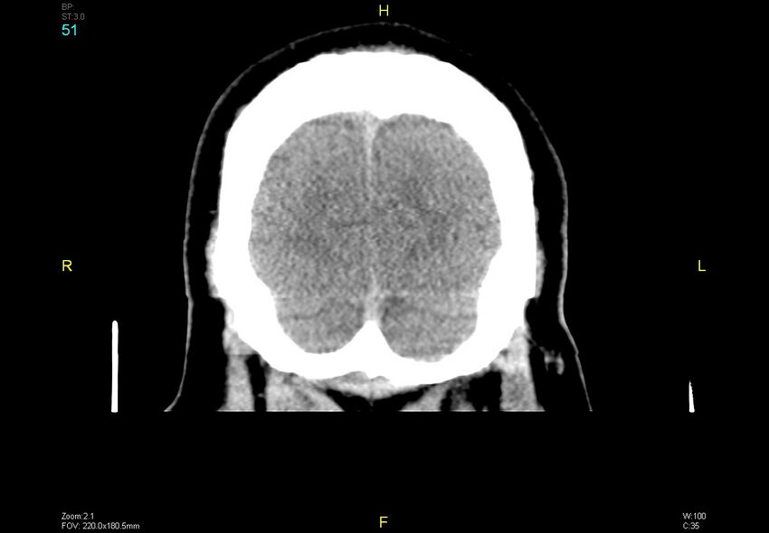 Bilateral medial medullary infarction (Radiopaedia 42220-45295 Coronal non-contrast 51).jpg