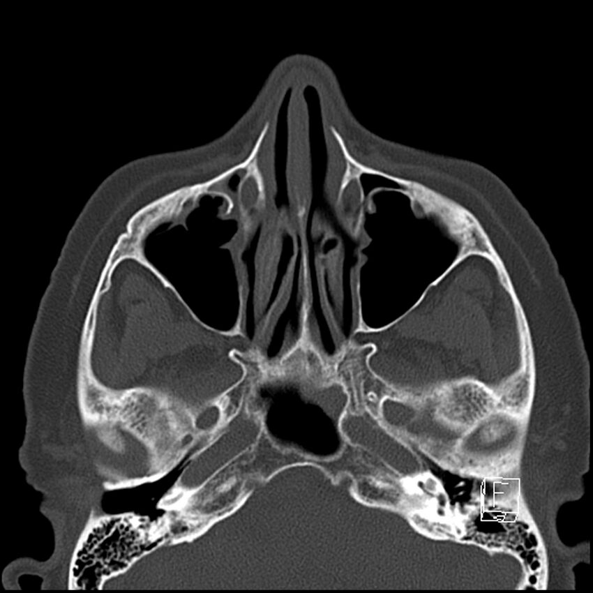 Bilateral palatine tonsilloliths on OPG and CT (Radiopaedia 75167-86247 Axial bone window 18).jpg