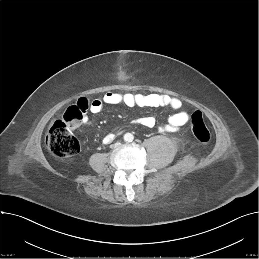 Bilateral psoas hematomas (Radiopaedia 24057-24279 A 50).jpg