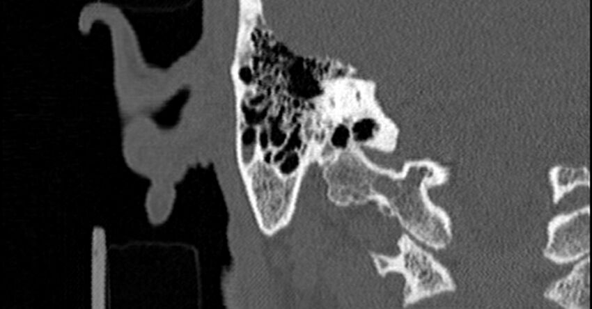 Bilateral temporal bone fractures (Radiopaedia 29482-29970 Coronal non-contrast 141).jpg