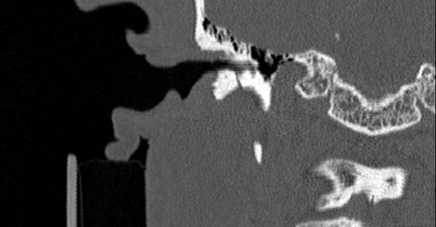 Bilateral temporal bone fractures (Radiopaedia 29482-29970 Coronal non-contrast 83).jpg