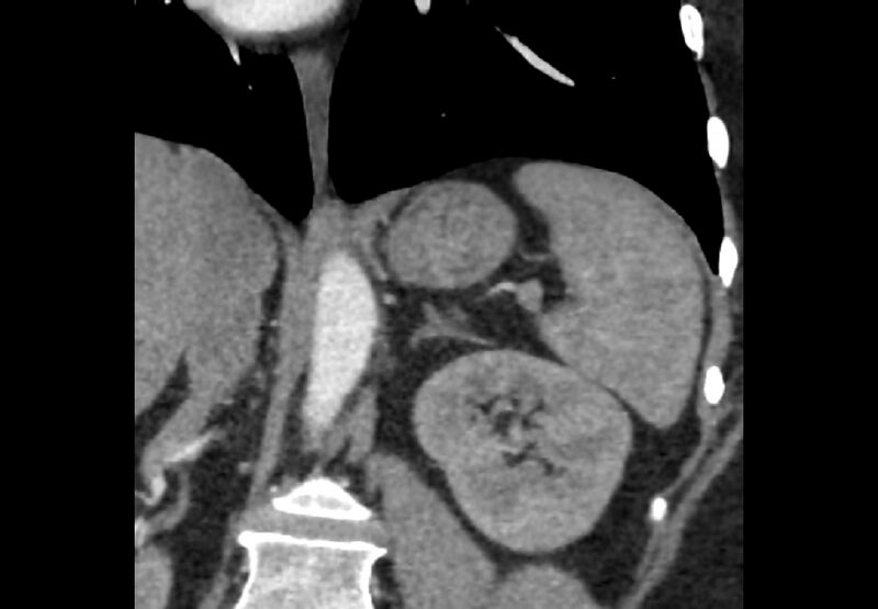 File:Bilateral urolithiasis with incidentally detected splenic artery aneurysm and left inferior vena cava (Radiopaedia 44467-48127 Ob. Cor. C+ Art. 1).jpg