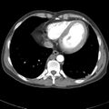 Biliary necrosis - liver transplant (Radiopaedia 21876-21845 A 3).jpg
