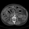 Biliary necrosis - liver transplant (Radiopaedia 21876-21846 A 36).jpg