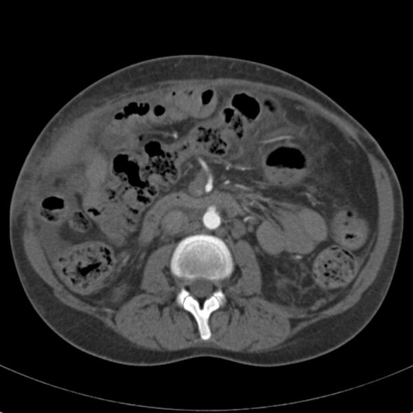 File:Biliary necrosis - liver transplant (Radiopaedia 21876-21846 A 36).jpg