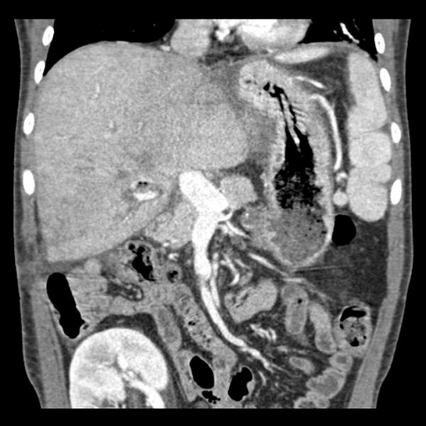 File:Biliary necrosis - liver transplant (Radiopaedia 21876-21846 C 21).jpg