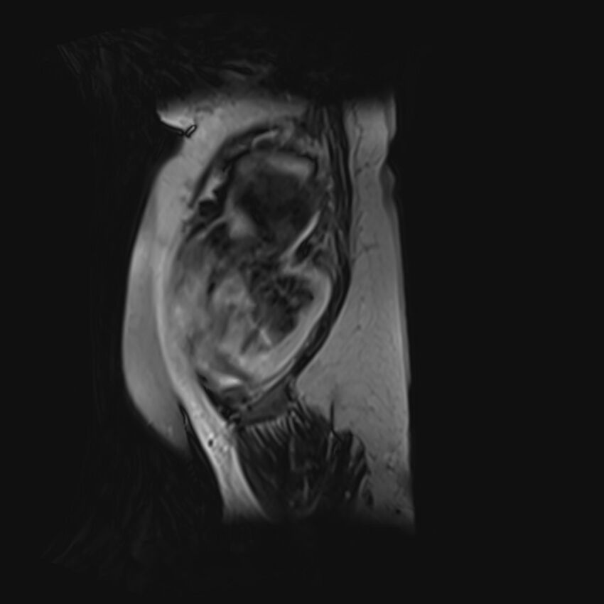 Bilobed placenta accreta (Radiopaedia 69648-79591 G 57).jpg