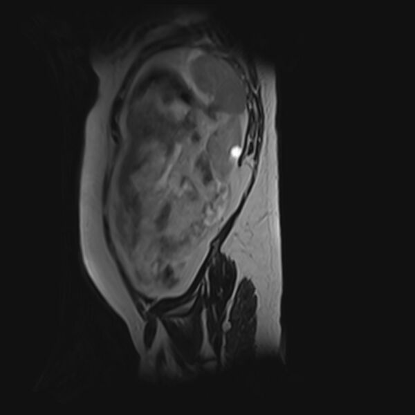 File:Bilobed placenta accreta (Radiopaedia 69648-79591 G 6).jpg