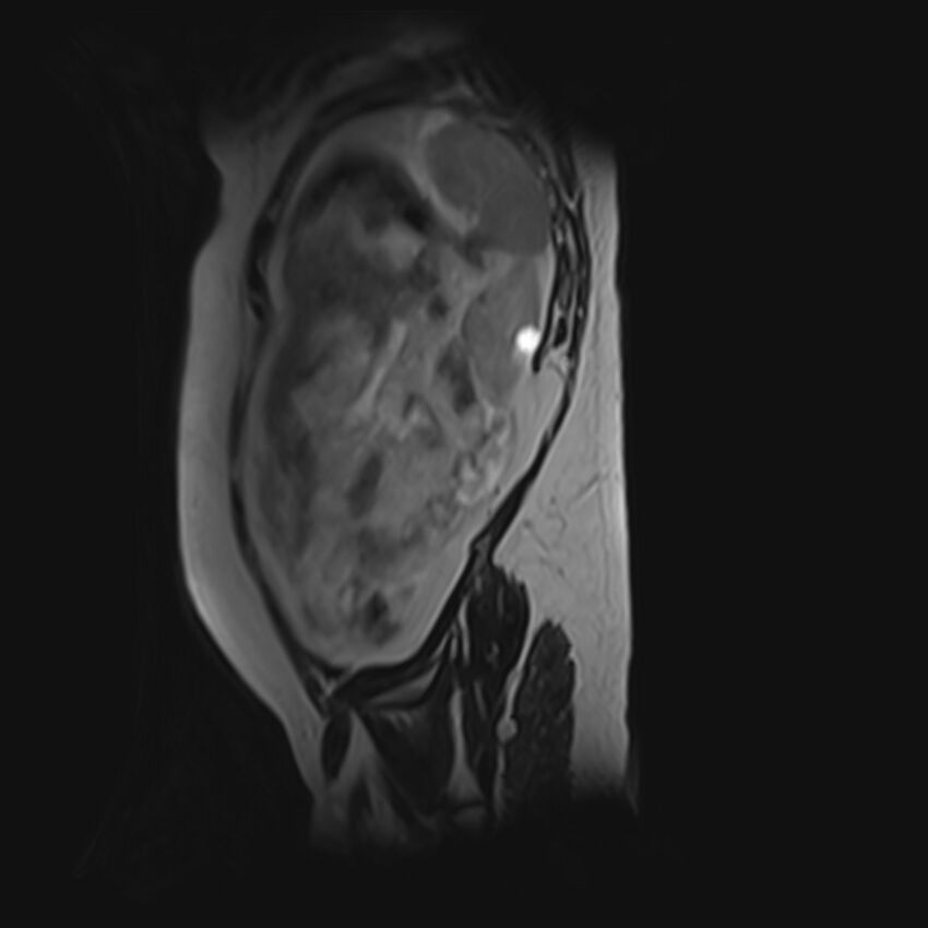 Bilobed placenta accreta (Radiopaedia 69648-79591 G 6).jpg