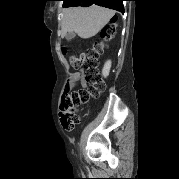 File:Bladder tumor detected on trauma CT (Radiopaedia 51809-57609 E 58).jpg