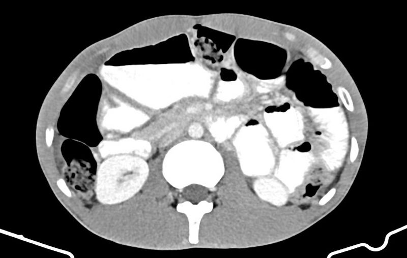 File:Blunt injury to the small bowel (Radiopaedia 74953-85987 A 68).jpg