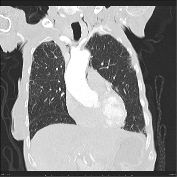 File:Boerhaave syndrome (Radiopaedia 26240-26362 Coronal lung window 10).jpg