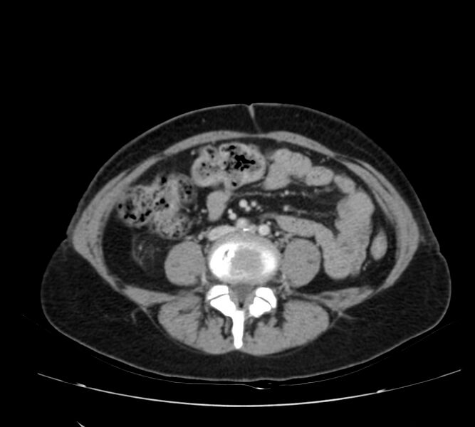 File:Bosniak renal cyst - type IV (Radiopaedia 22929-22953 C 39).jpg