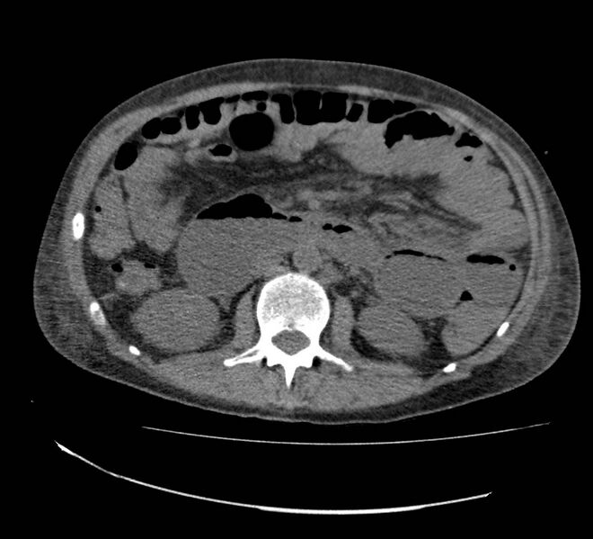 File:Bowel lymphoma complicated by bleeding after therapy (Radiopaedia 55601-62110 Axial non-contrast 37).jpg