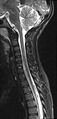 Brachial plexus birth palsy (Radiopaedia 68118-77604 Sagittal T2 7).jpg