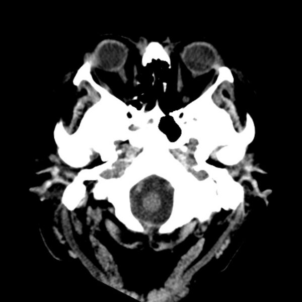 File:Brain cortical laminar necrosis (Radiopaedia 25822-25971 Axial non-contrast 3).jpg
