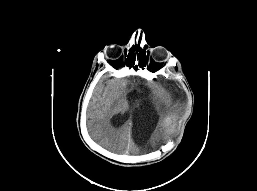 Brain injury by firearm projectile (Radiopaedia 82068-96088 A 129).jpg