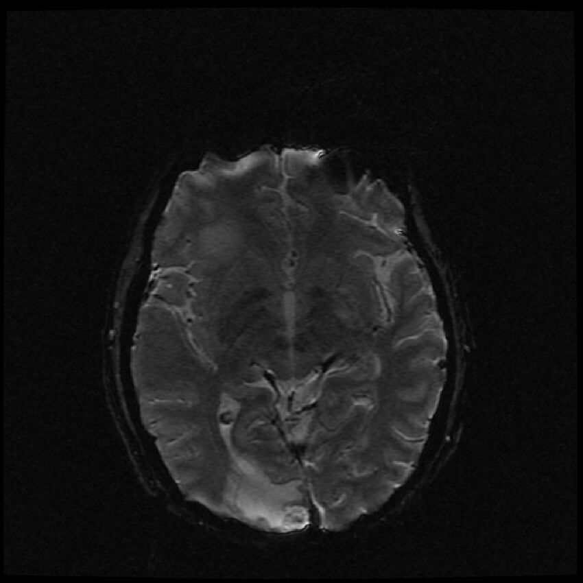 Brain metastases (renal cell carcinoma) (Radiopaedia 42571-45704 Axial SWI 34).jpg