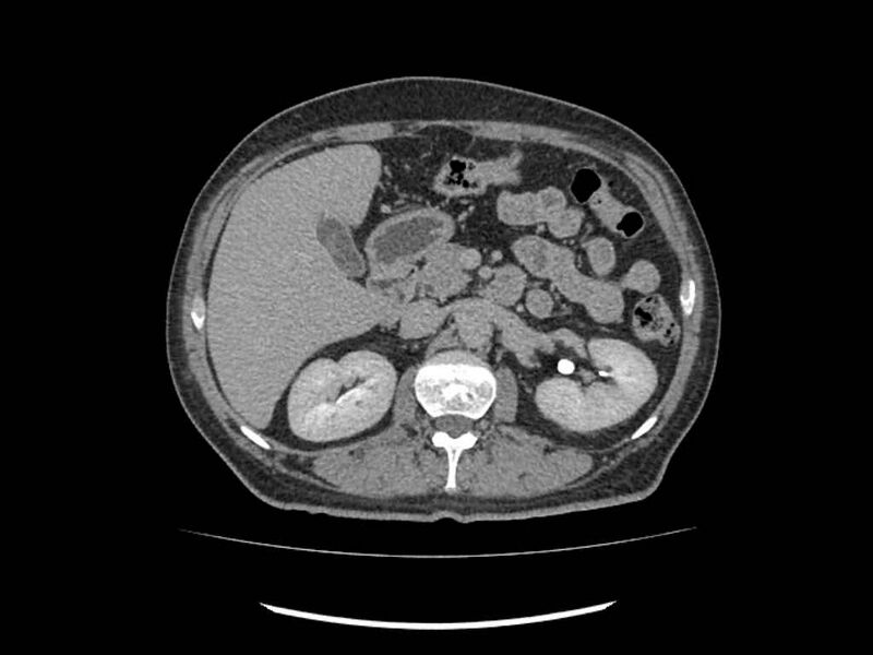 File:Brain metastases from renal cell carcinoma (Radiopaedia 42222-45328 Axial C+ delayed 73).jpg