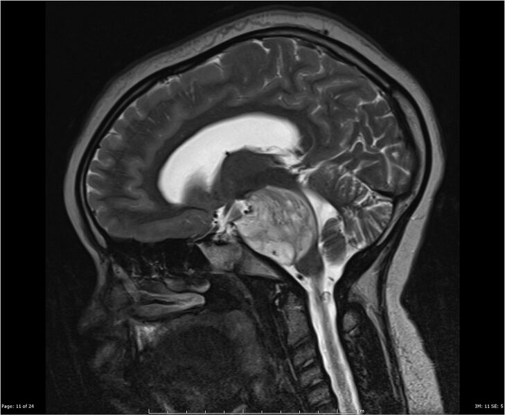 File:Brainstem glioma (Radiopaedia 21819-21775 Sagittal T2 11).jpg