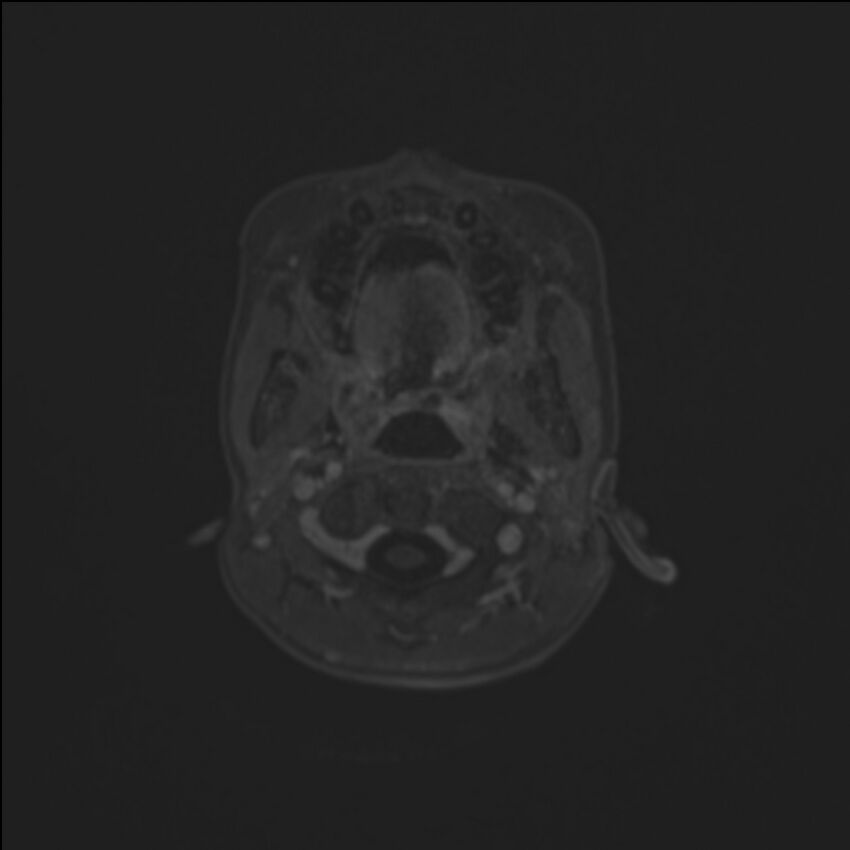 Brainstem glioma (Radiopaedia 70548-80674 Axial T1 C+ 7).jpg