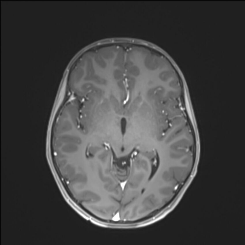 Brainstem glioma (Radiopaedia 70548-80674 Axial T1 C+ 78).jpg