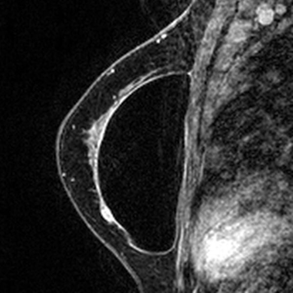 File:Breast implants - MRI (Radiopaedia 26864-27035 Sagittal T2 33).jpg