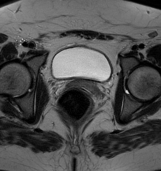 File:Broad ligament leiomyoma (Radiopaedia 81634-95516 Axial T2 20).jpg