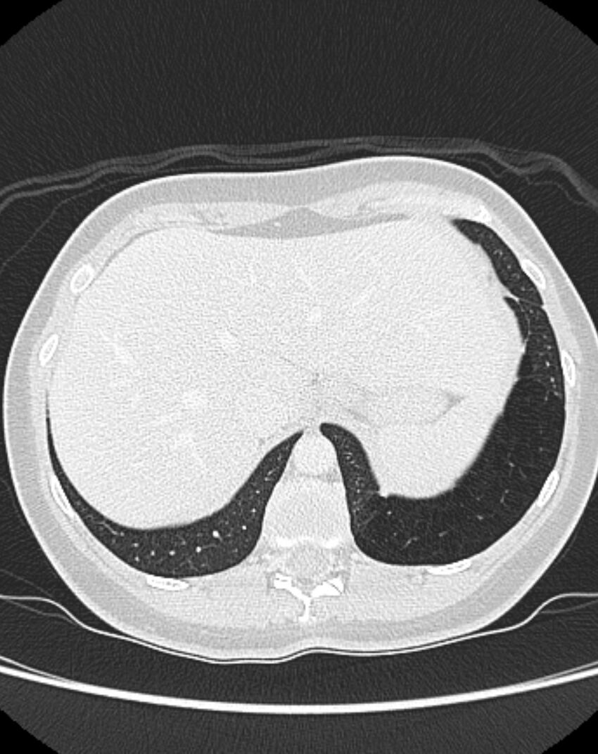 Bronchial atresia (Radiopaedia 50007-55297 Axial lung window 100).jpg