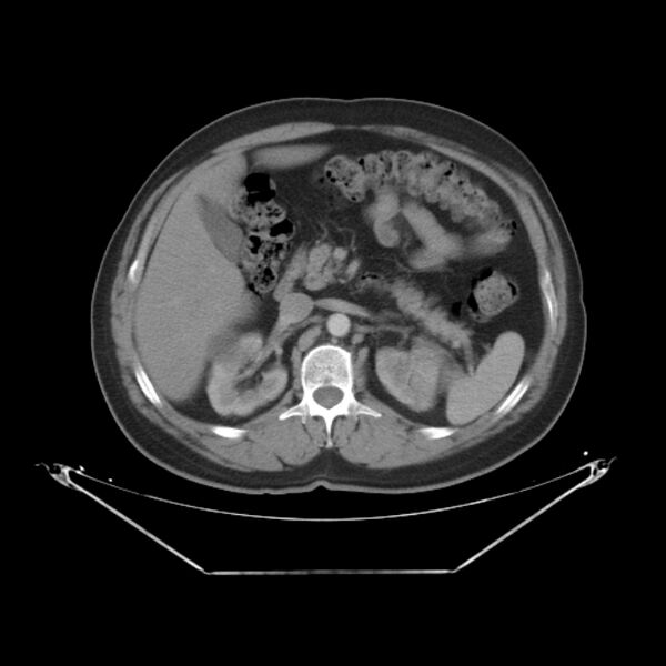 File:Bronchogenic carcinoma with upper lobe collapse (Radiopaedia 29297-29726 C 35).jpg