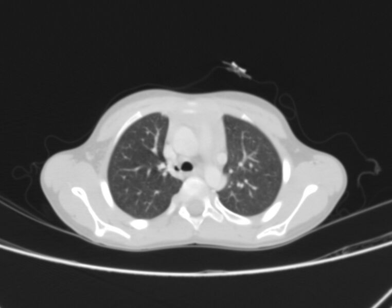 File:Bronchus suis (Radiopaedia 68131-77620 Axial lung window 16).jpg