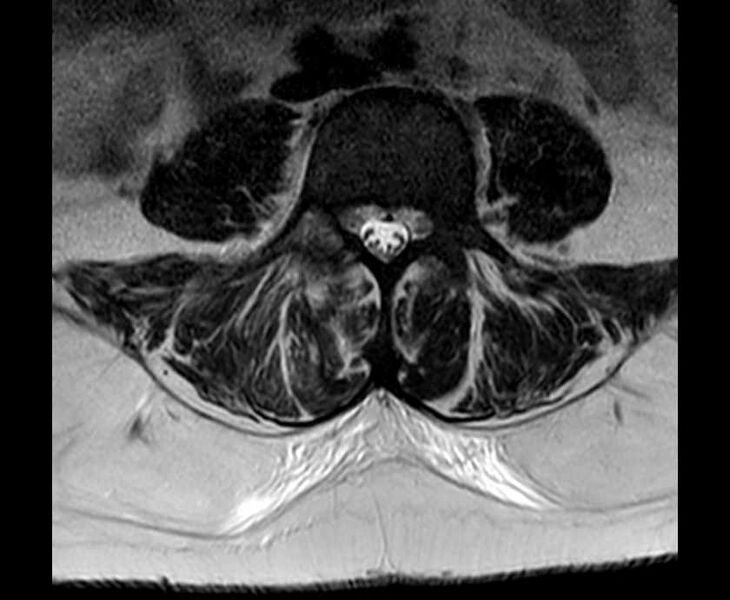 File:Brown tumors compressing the spinal cord (Radiopaedia 68442-78030 Axial T2 - lumbar 23).jpg