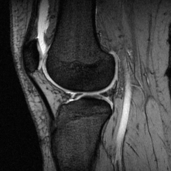 File:Bucket handle tear - medial meniscus (Radiopaedia 79028-91942 D 8).jpg