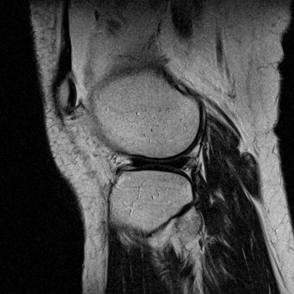 File:Bucket handle tear - medial meniscus (Radiopaedia 79028-91942 Sagittal T2 5).jpg