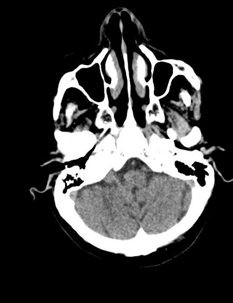File:Burnt-out meningioma (Radiopaedia 51557-57337 Axial non-contrast 5).jpg