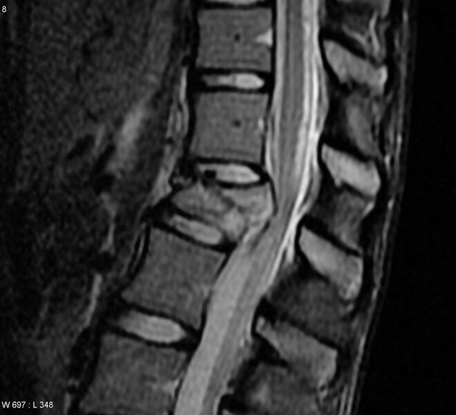 File:Burst lumbar fracture (Radiopaedia 4635-6718 Sagittal T2 1).jpg