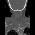 C1 anterior arch (plough) fracture - type 1 (Radiopaedia 76181-87720 Coronal bone window 7).jpg