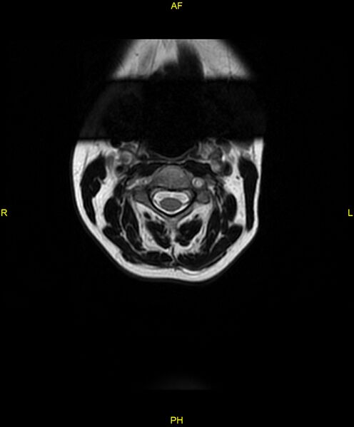 File:C5 nerve sheath tumor (Radiopaedia 85777-101596 Axial T2 2).jpg