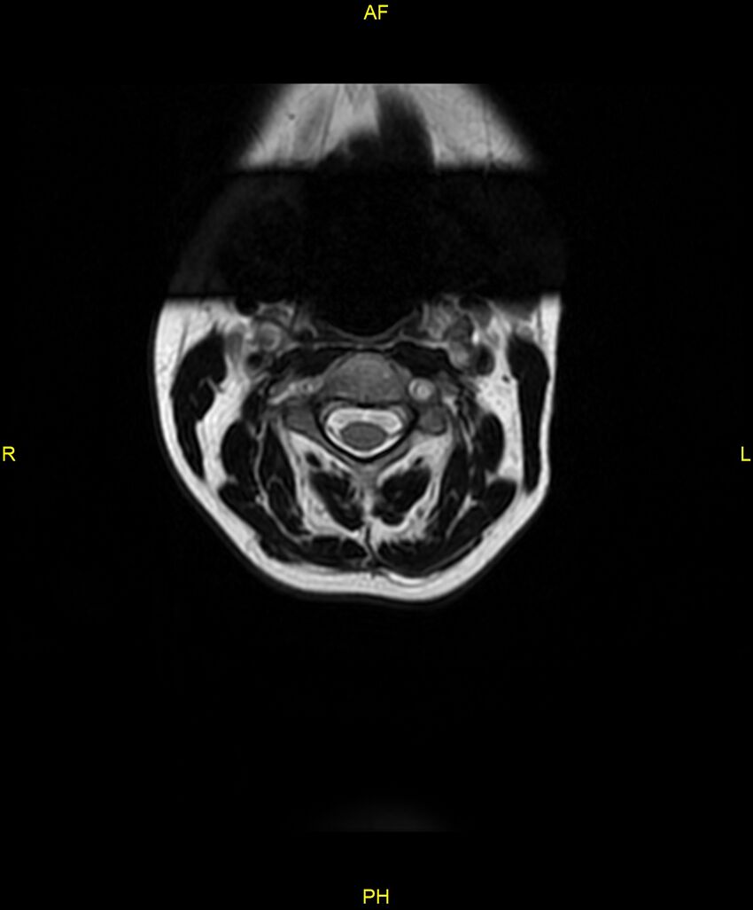C5 nerve sheath tumor (Radiopaedia 85777-101596 Axial T2 2).jpg