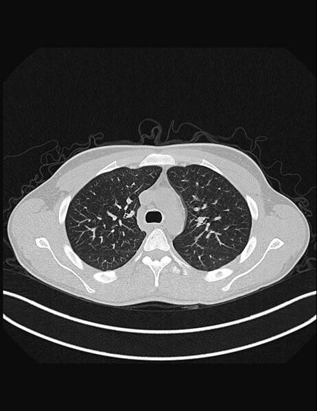 File:Calcifying pulmonary metastases (Radiopaedia 33359-34396 Axial lung window 20).jpg