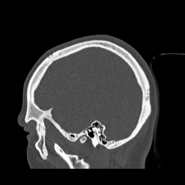 File:Calvarial osteoma (Radiopaedia 36520-38079 Sagittal bone window 26).jpg